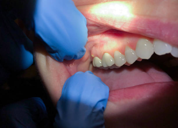 Best Emergency Dental Services for Seniors in Apex, NC