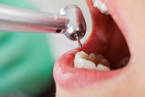 Best Emergency Dentist for Knocked-Out Tooth in Apex, NC